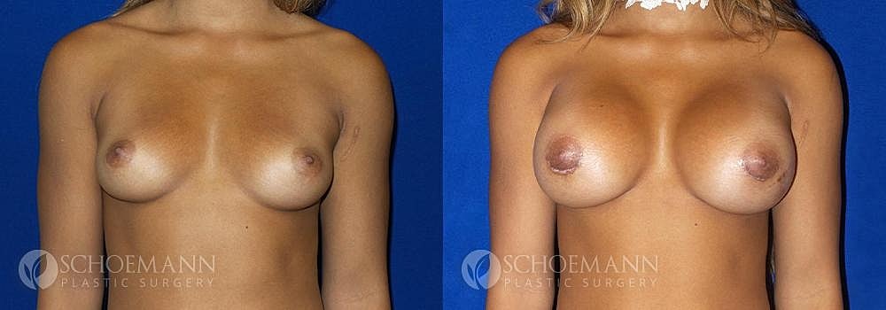 Breast Augmentation Before & After