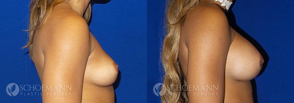 Breast Augmentation Before & After
