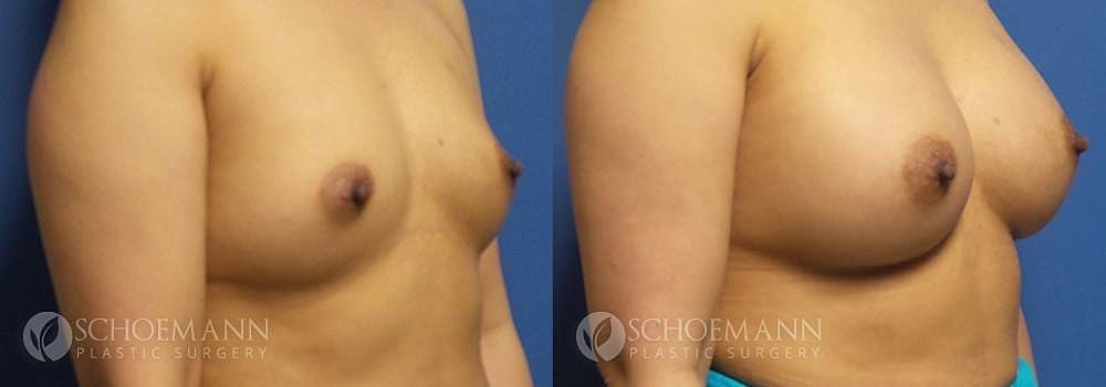 Breast Augmentation Before & After