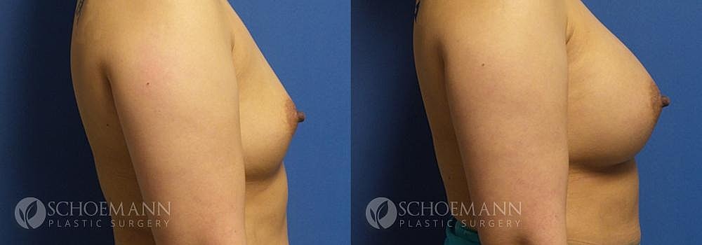 Breast Augmentation Before & After