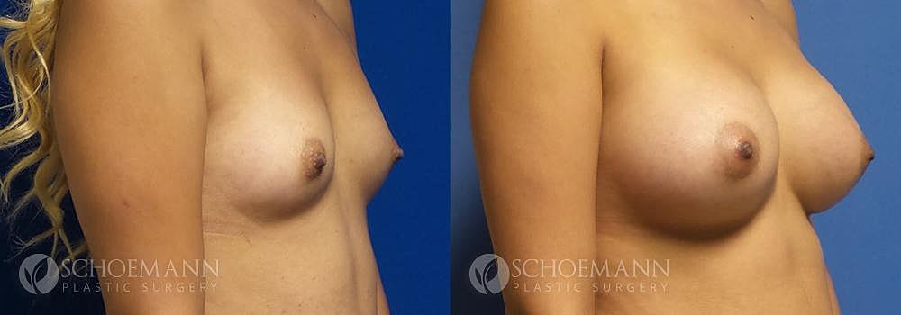 Breast Augmentation Before & After