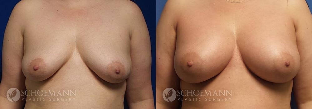 Breast Augmentation Before & After