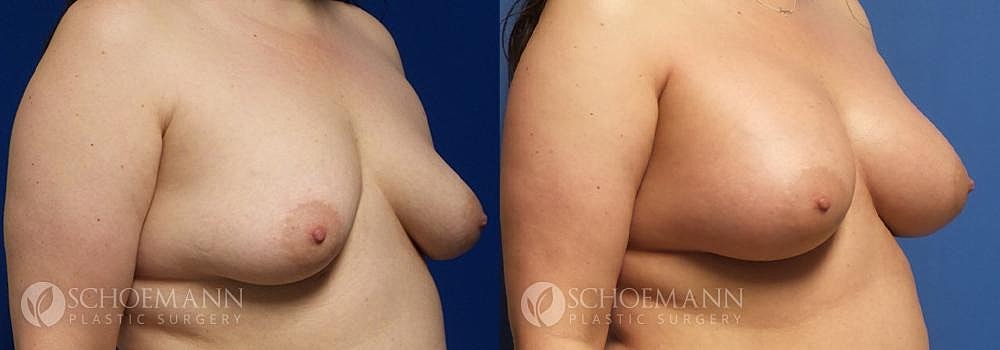 Breast Augmentation Before & After