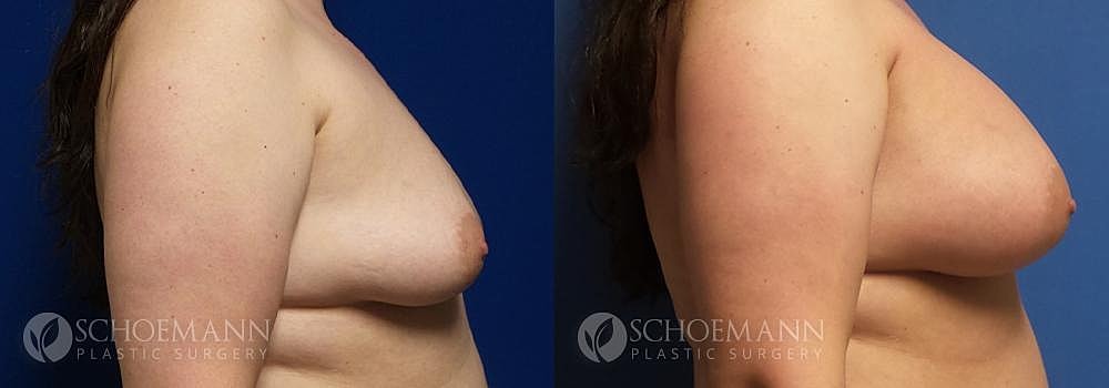 Breast Augmentation Before & After