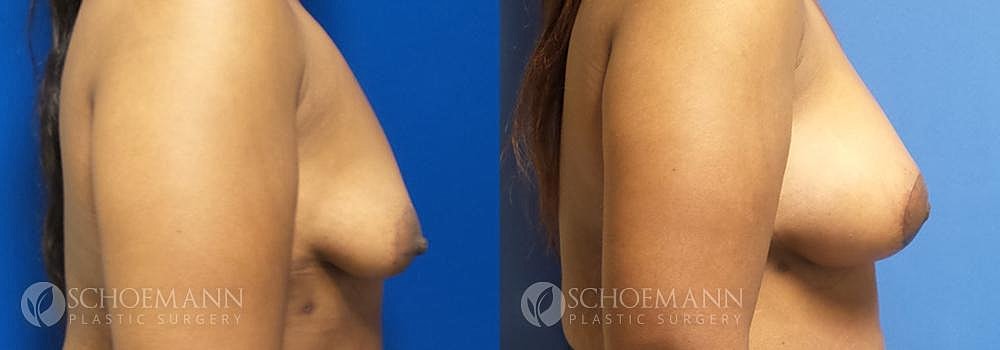 Breast Augmentation Before & After