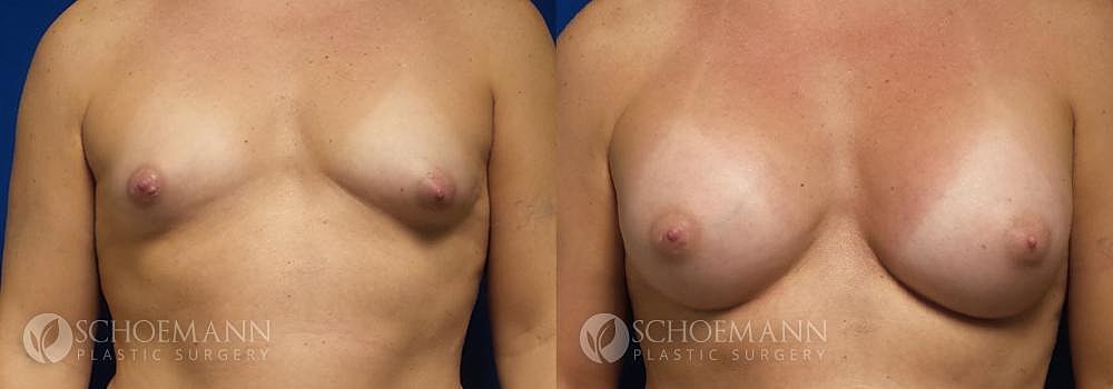 Breast Augmentation Before & After