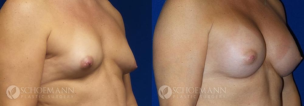 Breast Augmentation Before & After