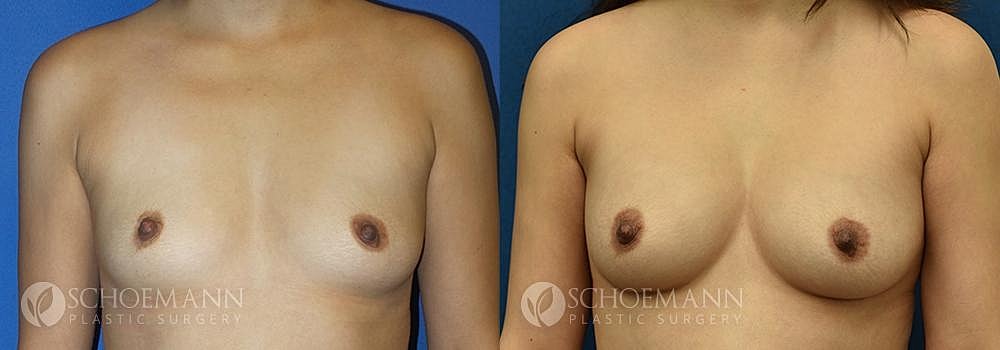 Breast Augmentation Before & After