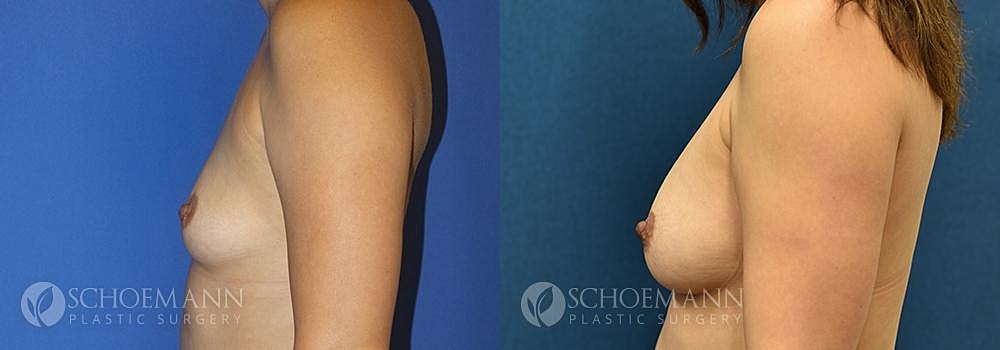 Breast Augmentation Before & After