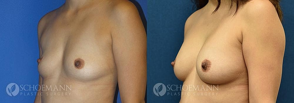 Breast Augmentation Before & After