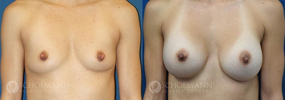 Breast Augmentation Before & After