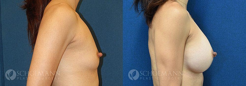 Breast Augmentation Before & After