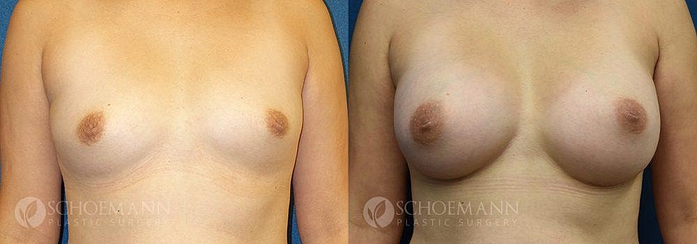 Breast Augmentation Before & After