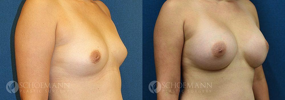 Breast Augmentation Before & After