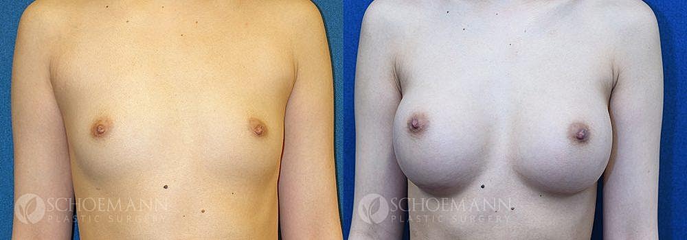 Breast Augmentation Before & After