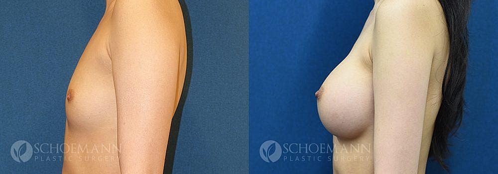Breast Augmentation Before & After