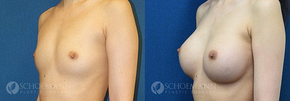 Breast Augmentation Before & After