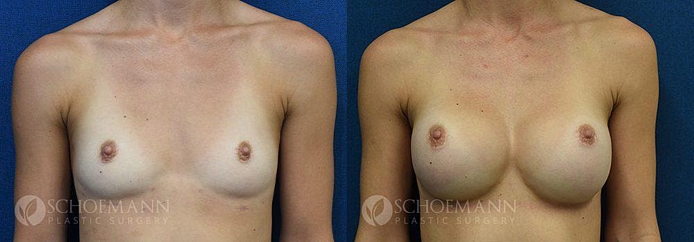 Breast Augmentation Before & After