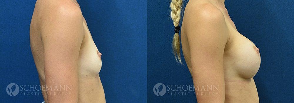Breast Augmentation Before & After