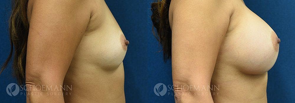 Breast Augmentation Before & After