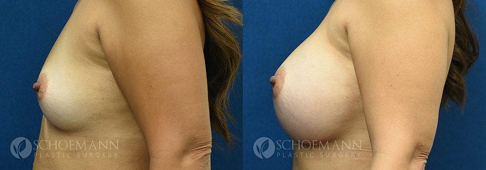 Breast Augmentation Before & After
