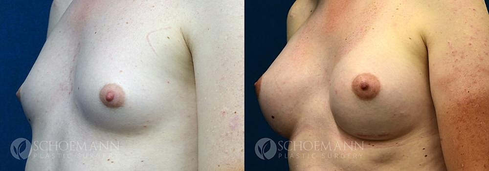 Breast Augmentation Before & After