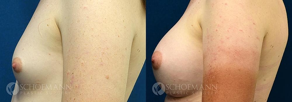 Breast Augmentation Before & After