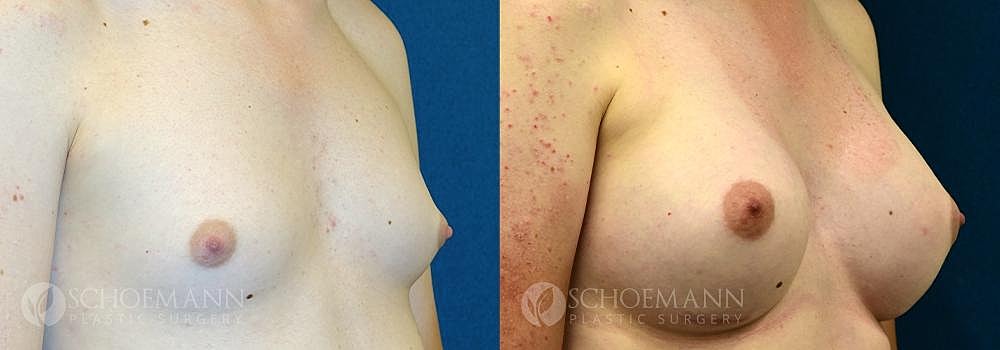 Breast Augmentation Before & After
