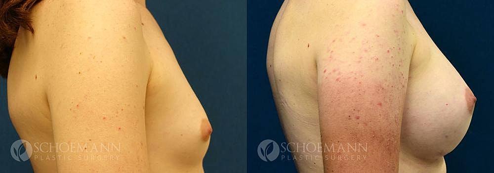 Breast Augmentation Before & After