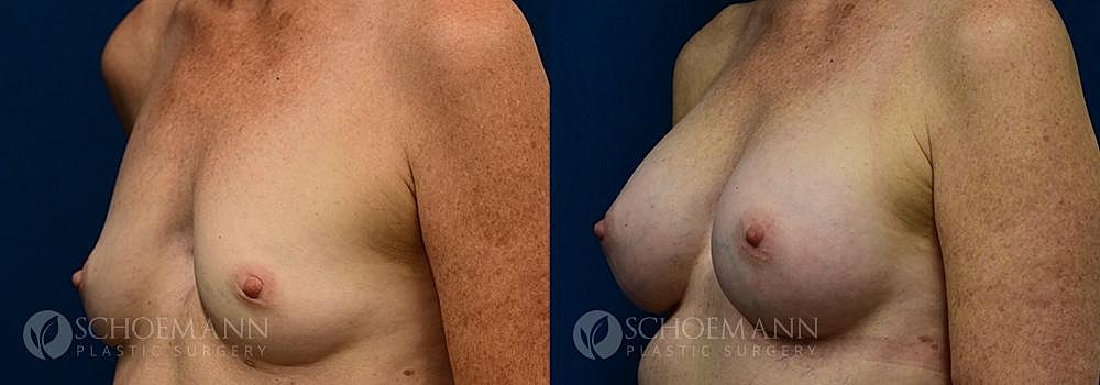 Breast Augmentation Before & After