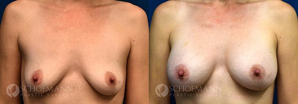 Breast Augmentation Before & After