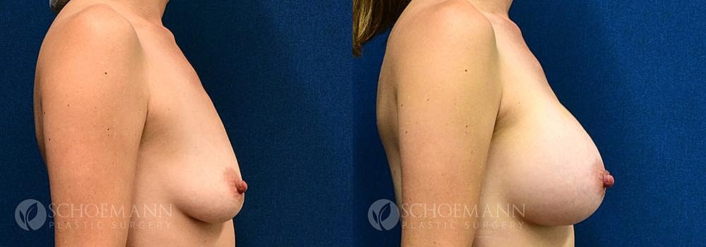 Breast Augmentation Before & After