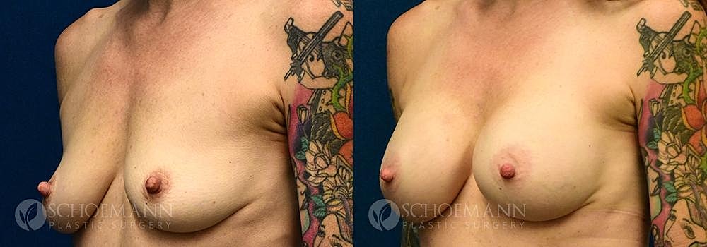 Breast Augmentation Before & After