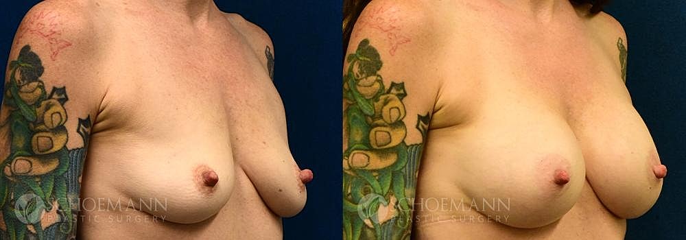 Breast Augmentation Before & After