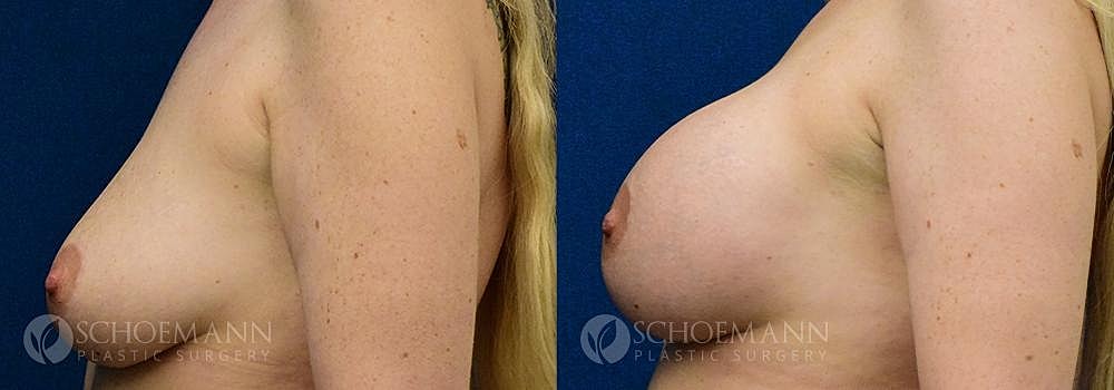 Breast Augmentation Before & After