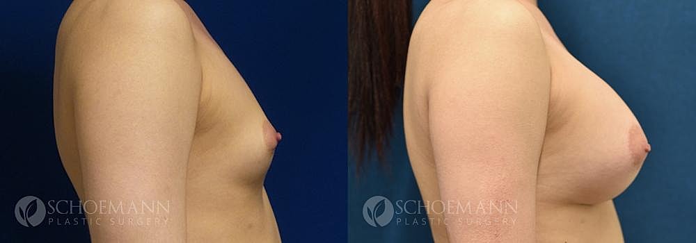 Breast Augmentation Before & After