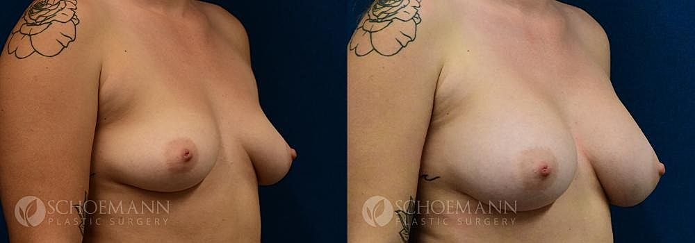 Breast Augmentation Before & After