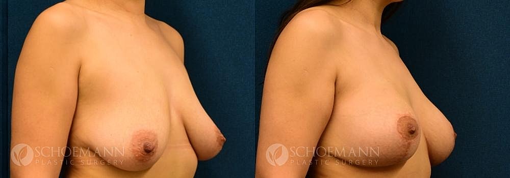 Breast Lift Before & After