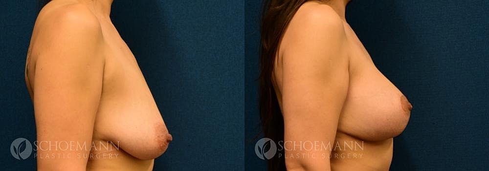 Breast Lift Before & After