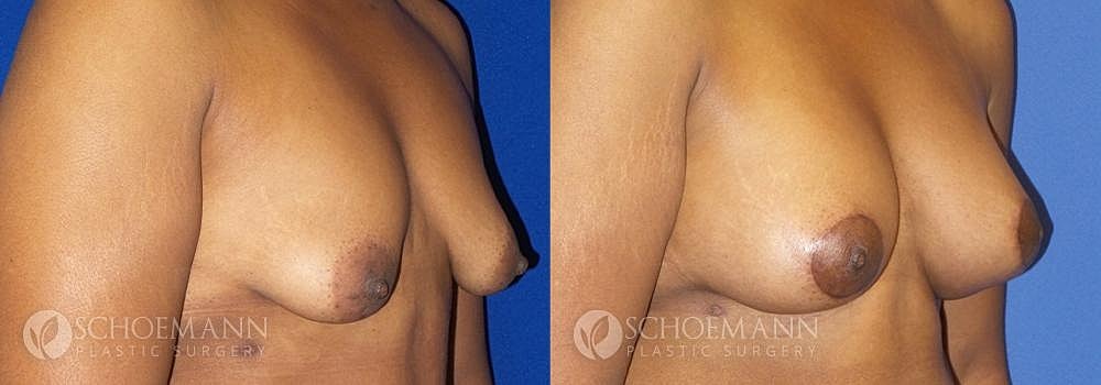 Breast Lift Before & After