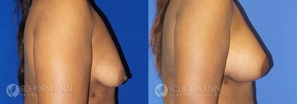 Breast Lift Before & After