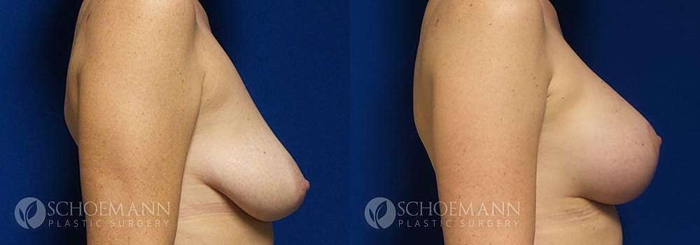 Breast Lift Before & After