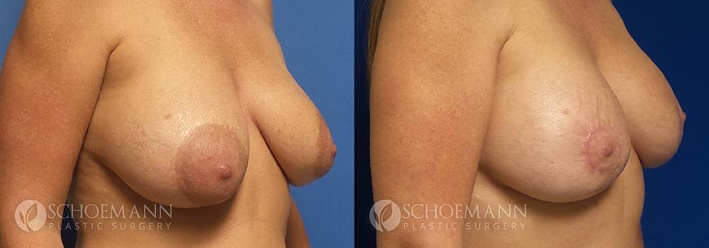Breast Lift Before & After