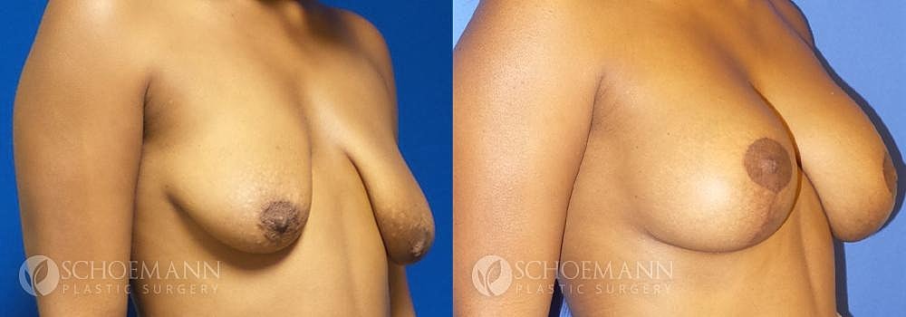 Breast Lift Before & After