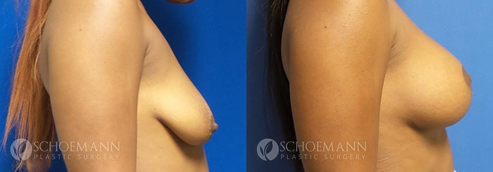 Breast Lift Before & After