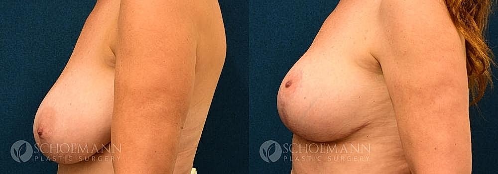 Breast Lift Before & After