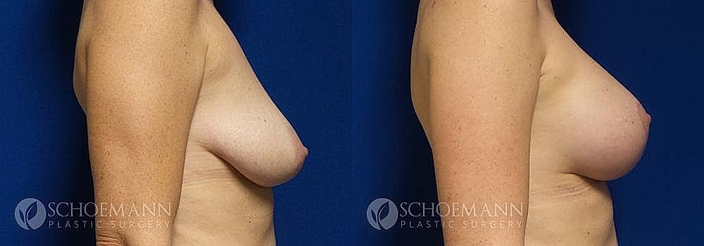 Breast Lift Before & After