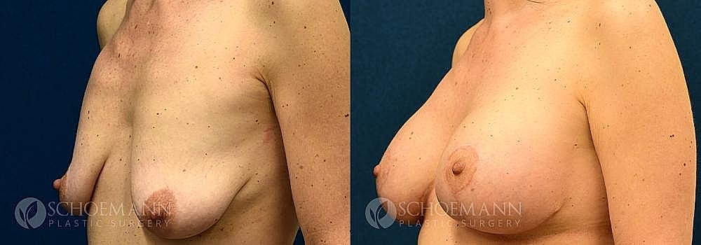 Breast Lift Before & After