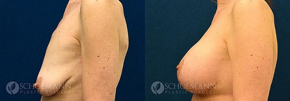 Breast Lift Before & After