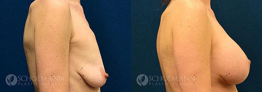 Breast Lift Before & After